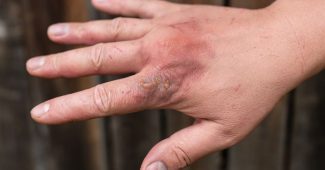 Brûlure légère : que faire pour un traitement efficace