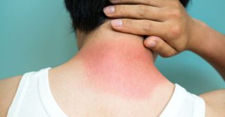 Coup de soleil sévère : que faire pour un soulagement immédiat