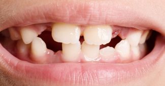 Options pour le remplacement de plusieurs dents manquantes
