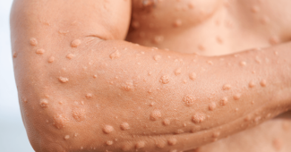 Tout savoir sur la kératose pilaire et comment l’atténuer