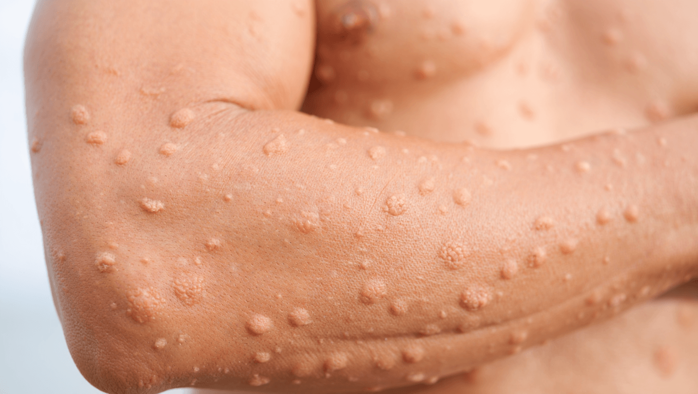 Tout savoir sur la kératose pilaire et comment l’atténuer