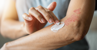 Émollient eczéma : comment bien le choisir ?