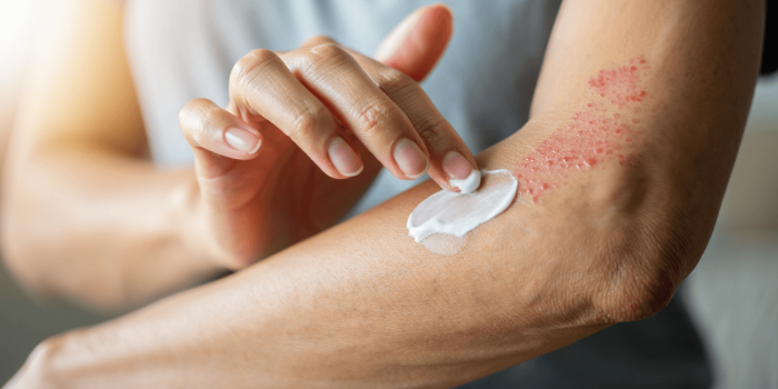 Émollient eczéma : comment bien le choisir ?