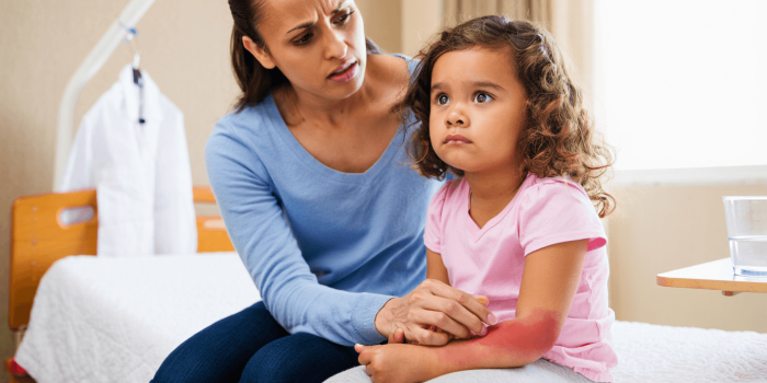 Éruption cutanée chez l’enfant et prise de médicament : que faire ?