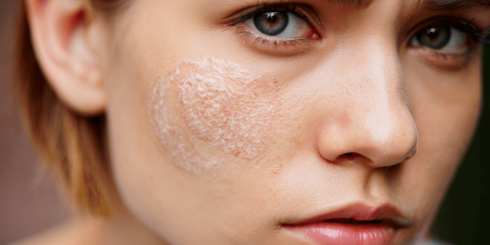 Tout savoir sur les dartres : causes, symptômes et solutions