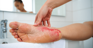 Eczéma pied : tout ce qu’il faut savoir pour enfin le soulager