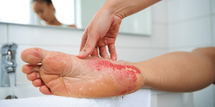 Eczéma pied : tout ce qu’il faut savoir pour enfin le soulager
