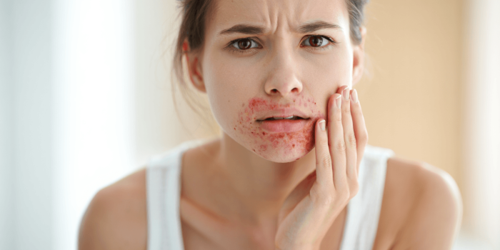 Dermatite périorale et rougeurs autour de la bouche : ce que vous auriez aimé savoir dès le début
