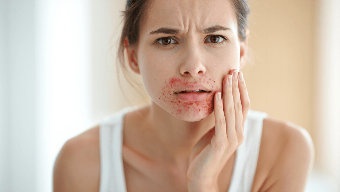 Dermatite périorale et rougeurs autour de la bouche : ce que vous auriez aimé savoir dès le début