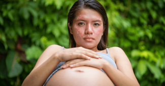 L'eczéma de grossesse (ou eczéma gestationnel) : causes, symptômes et solutions naturelles pour l'apaiser en toute sécurité.