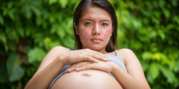 L'eczéma de grossesse (ou eczéma gestationnel) : causes, symptômes et solutions naturelles pour l'apaiser en toute sécurité.