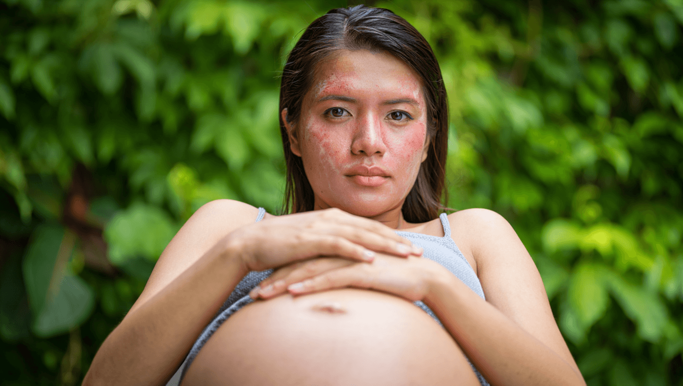 L'eczéma de grossesse (ou eczéma gestationnel) : causes, symptômes et solutions naturelles pour l'apaiser en toute sécurité.