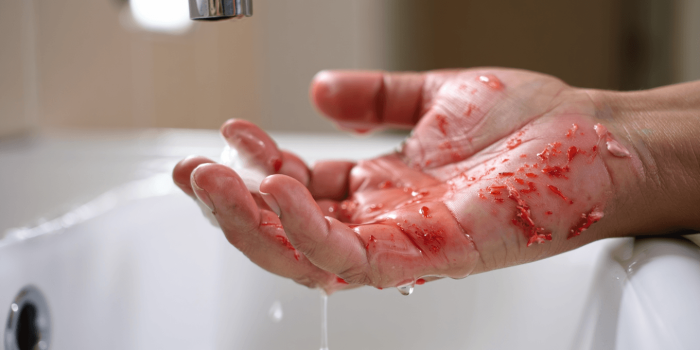 Eczéma contagieux : ce qu’il faut vraiment savoir