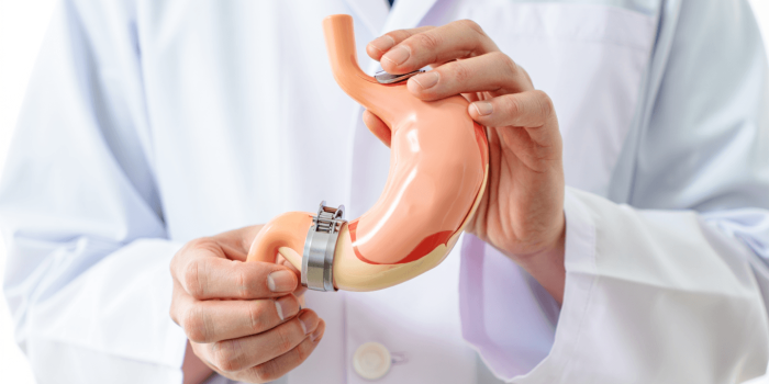 Anneau gastrique : fonctionnement, indications et résultats