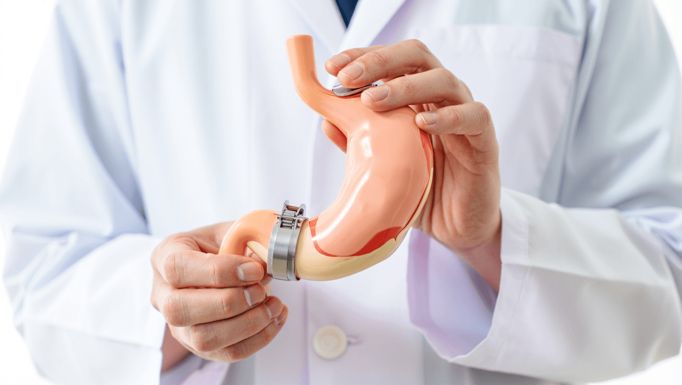 Anneau gastrique : fonctionnement, indications et résultats