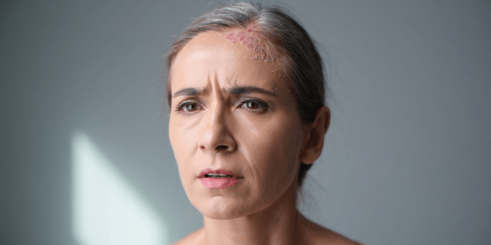 Psoriasis du cuir chevelu : reconnaître les symptômes et soulager les plaques naturellement