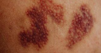 Comment savoir si un hématome est grave ?-IFSS