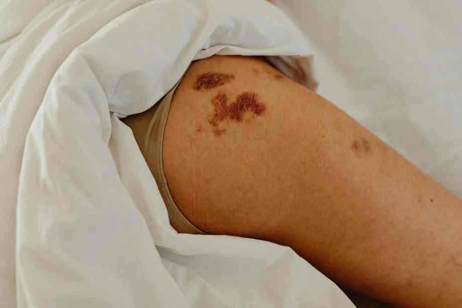Reconnaître les signes d'un hématome sérieux-IFSS